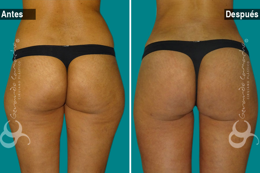 Glúteos definidos gracias a gluteoplastia en Bogotá